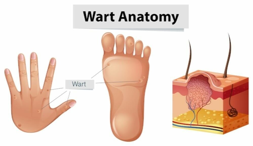 Successful removal of warts including roots with Removio