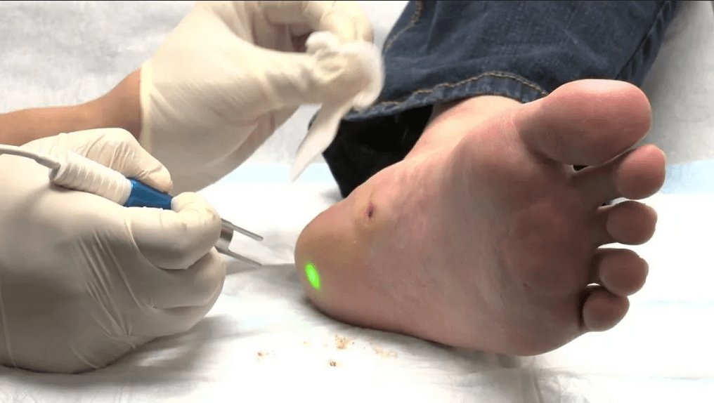 Treatment of plantar warts