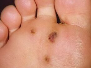 How to get rid of a plantar farm