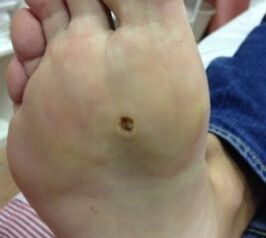 Opportunities to remove warts on the sole of the legs