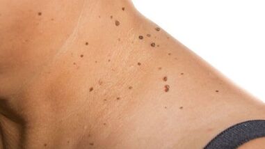 How to get rid of papilloma around your neck