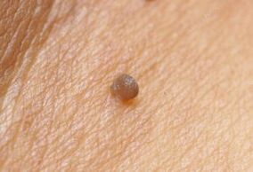 Clinical image of the papilloma