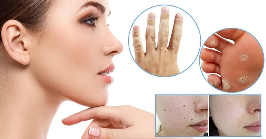 Papilloma distance methods