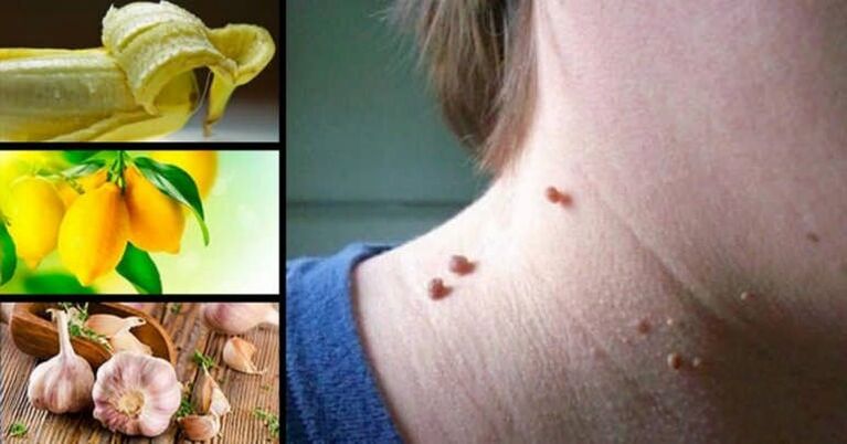 What are papillomas