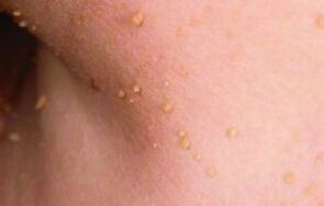 The reasons for the occurrence of papillomas on the body