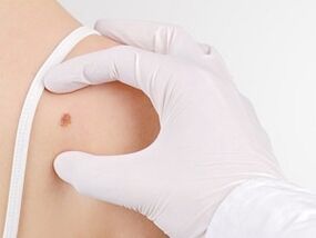 What is the danger of papillomas on the body