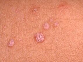 how to get rid of papillomas on the body