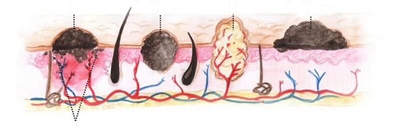 Types of papillomas on the human body
