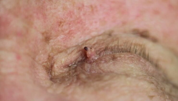 Papilloma on the eyelid, how to get rid of it