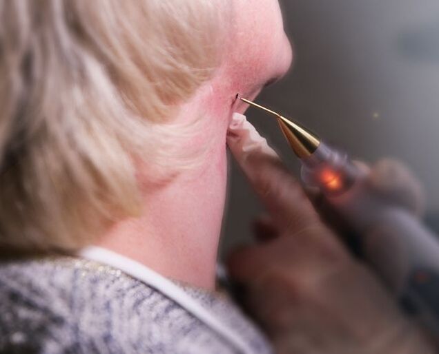 The process of removing papillomas on a woman's neck