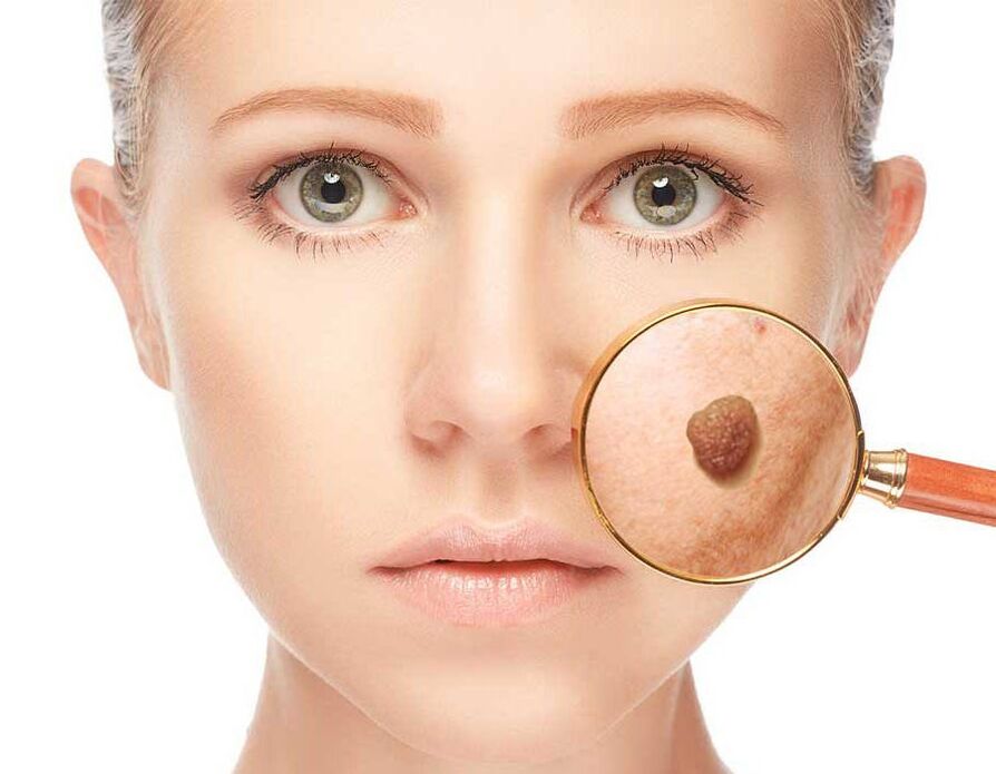 Papilloma on the face