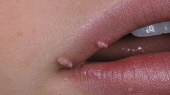 Papillomas on the lips
