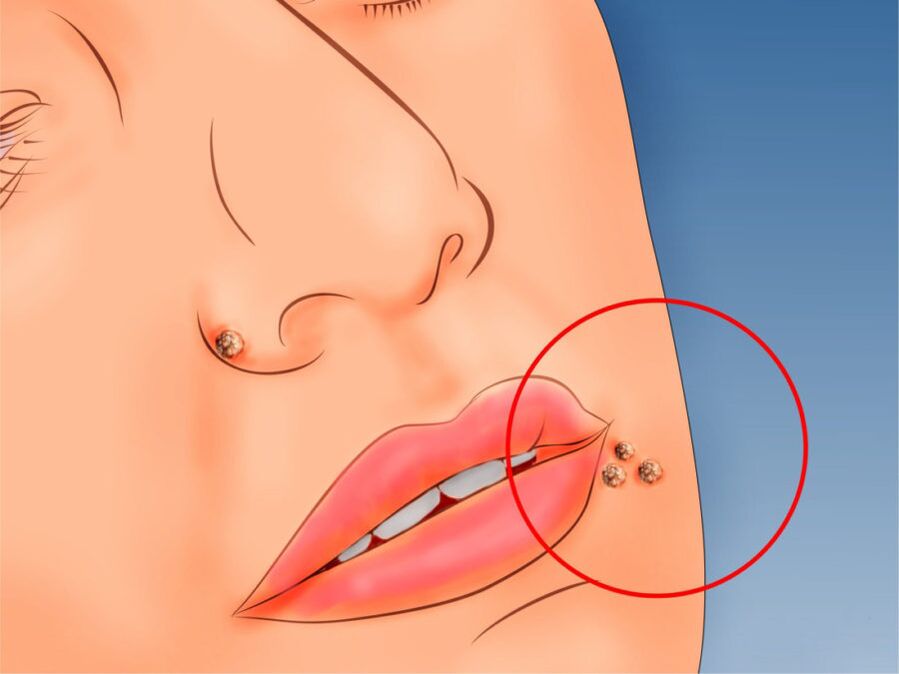 Papillomas on the face