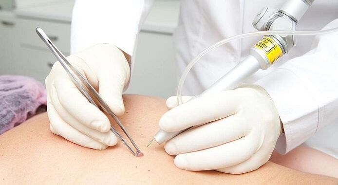 Laser removal of papillomas with papilloma viruses