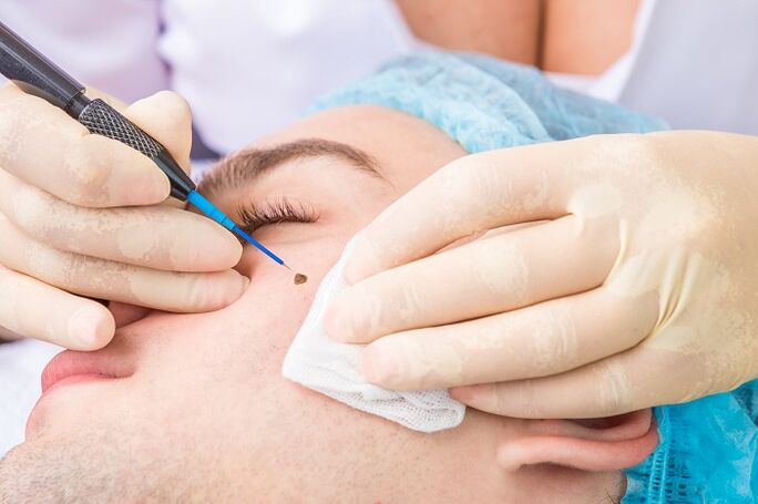 Removal of papillomas on the face due to the human papilloma virus